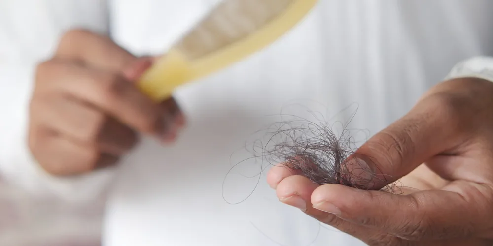 Kadınlarda Hormonal Saç Dökülmesi: Nedenleri ve Değerlendirme